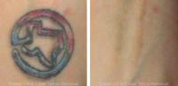 Eraser Clinic Laser Tattoo Removal image 3